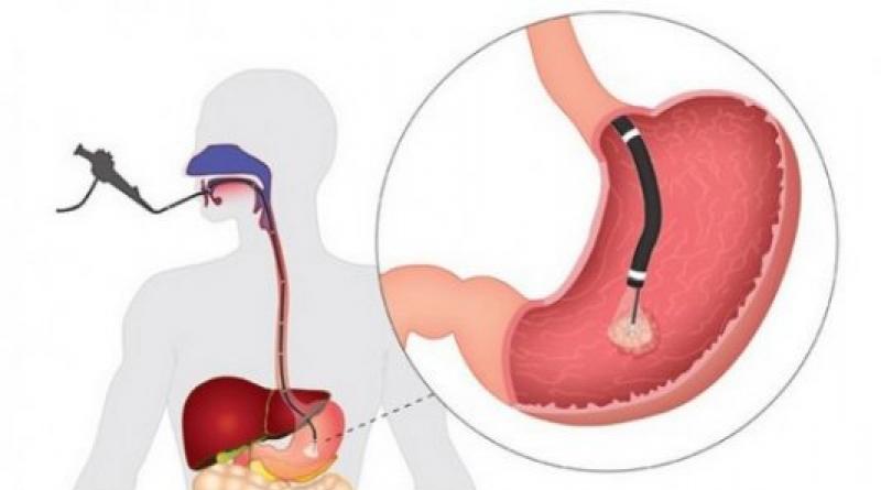 Preparazione per la gastroscopia dello stomaco Procedura gastroscopia della preparazione dello stomaco per l'esame