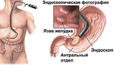 Симптомы хронического дуоденита. Гастродуоденит эрозивный бульбит. Язва желудка гастроскопия. Дуоденит 12 перстной кишки.