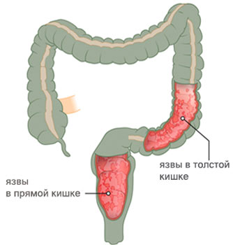 Болезненный кишечник. Эндометриоз сигмовидной кишки. Язвенный колит толстой кишки.